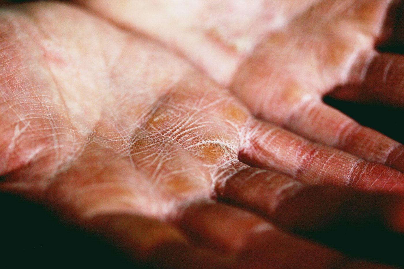 Close-up of dry, cracked and peeling skin on a person's palms, typical of eczema and other inflammatory rashes.
